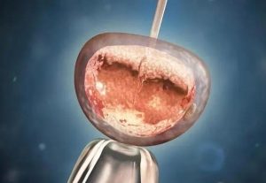 【仁济试管-生育秘诀】你的冷冻胚胎安全吗？