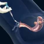 「什么是空卵泡」空卵泡注意事项有哪些 「什么是空卵泡」空卵泡注意事项有哪些