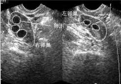 卵子透明带薄 卵子透明带薄怎么调理