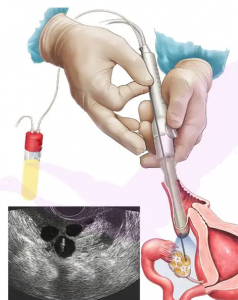 武汉试管婴儿一般费用是多少？ 武汉借卵试管费用在哪？