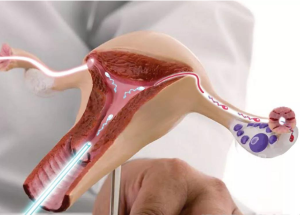 染色体异常能不能做供供卵试管婴儿