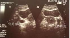 马来西亚试管助孕公司，有自助到马来西亚做三代试管成功的吗