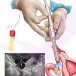 单角子宫怀孕如何保胎 单角子宫怀孕注意事项