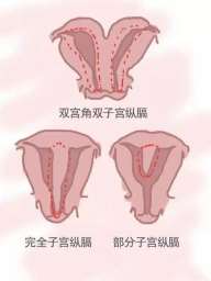 海口三代试管是如何确定性别的(海口试管流程)