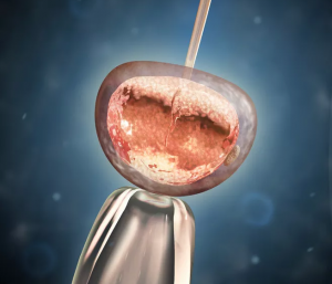 石家庄如果绝经了还能做试管婴儿吗,卵巢早衰了