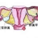 张家口三代试管是要养囊后再筛查吗 张家口三代试管是要养囊后再筛查吗