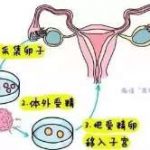 (如何收费)高龄绝经供卵试管婴儿