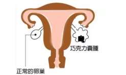 染色体平衡易位三代试管成功概率高[中国试管婴儿]