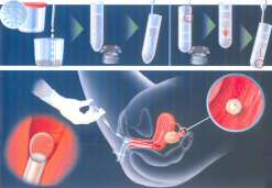 俄罗斯卵泡小能做试管婴儿吗