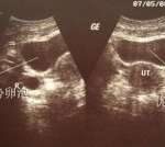 中信湘雅医院三代试管生男孩费用是多少